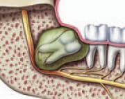 wisdom teeth cyst goodsamdentalimplants