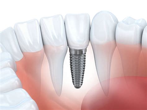 Dental Implant Good Samaritan