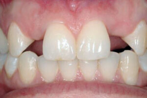 Congenitally Missing Teeth by-good-samaritan-dental-implants