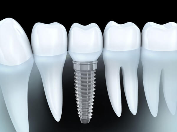 The Benefits Of Dental Implants: Get a Healthy, Natural-Looking Smile.