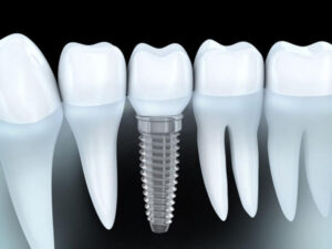 different-from-larger-dental-implant-providers-Good-Samaritan
