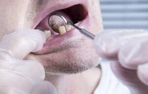 problems missing teeth Good Samaritan dental implant instititute