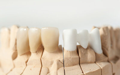 Examining the Differences Between a Bridge and a Dental Implant