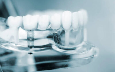 How Costly Is Personalized Implant Care for a Beautiful Smile?
