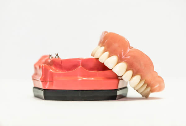 dentures-vs-dental-implants-good-samaritan