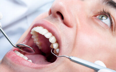 Teeth Whiteners: Safe for Oral Health?