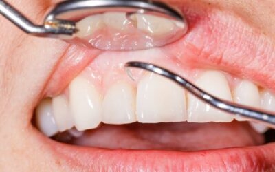 Gum Disease: What You Need To Know About Gingivitis and Periodontitis