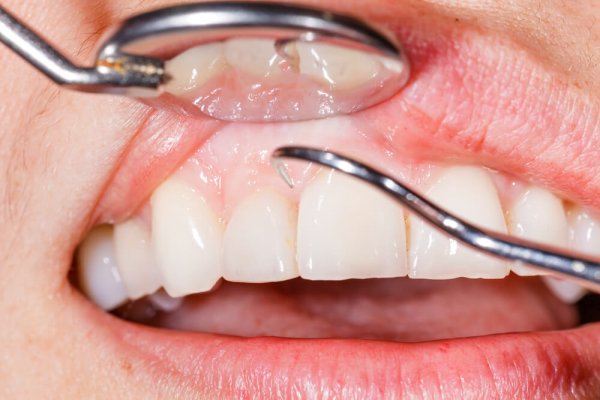 Gum Disease: What You Need To Know About Gingivitis and Periodontitis