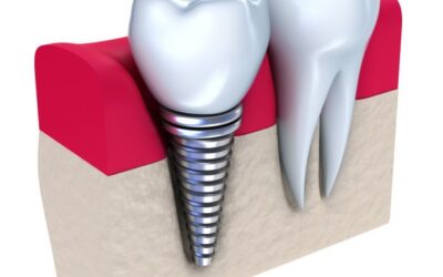 Dental Implants Are Possible Among Osteoporosis Patients