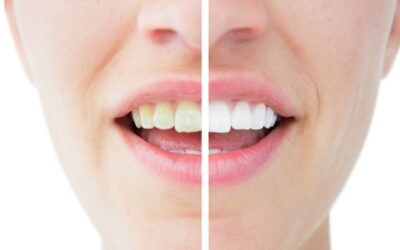 Transform Your Smile With These Common Cosmetic Dentistry Procedures