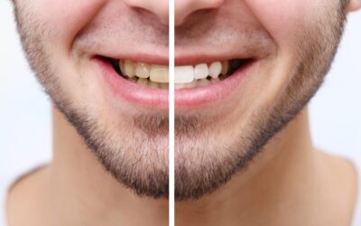 Natural Teeth Whitening — Does It Really Work? 