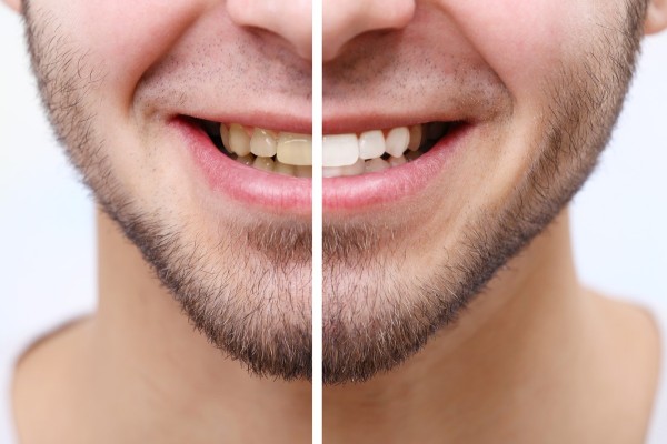 Natural Teeth Whitening — Does It Really Work? 