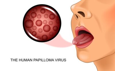 HPV Infection and Oropharyngeal Cancer 