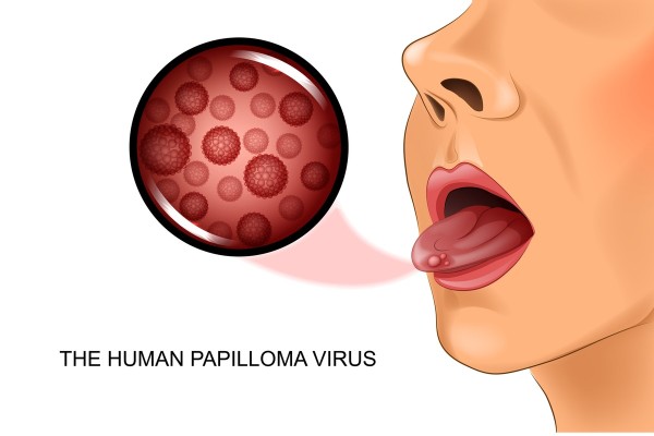 HPV Infection and Oropharyngeal Cancer 