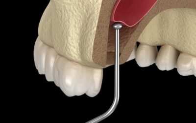 What to Expect if You Need a Sinus Lift Before Getting Dental Implants 