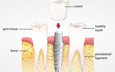 Understanding the Anatomy of a Dental Implant and How it Works