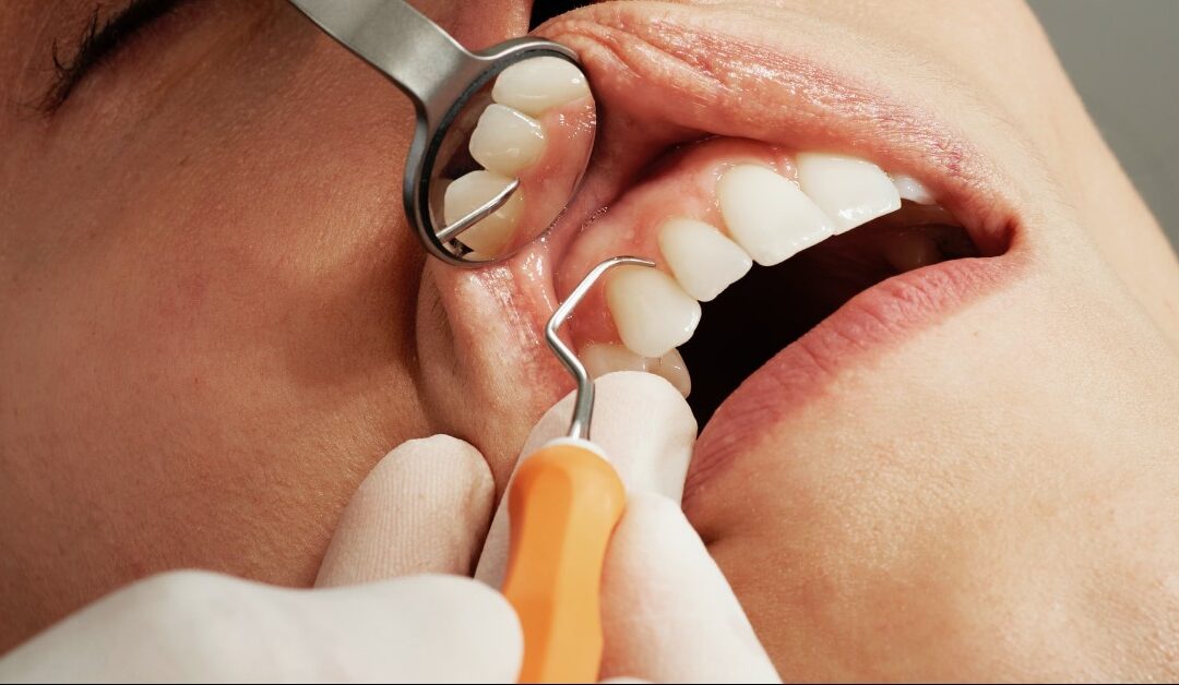 How Long Can I Expect My Dental Implants to Last?