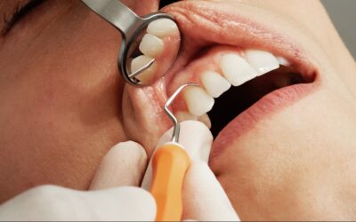 How Long Can I Expect My Dental Implants to Last?