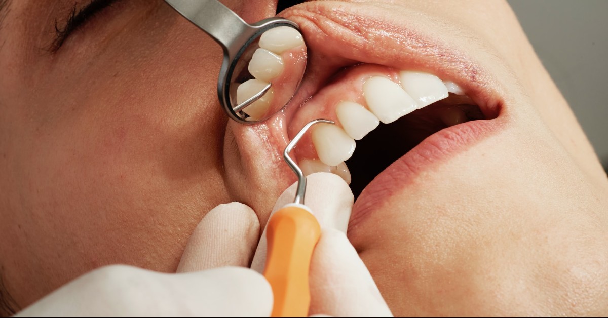 Lifespan Of Dental Implants-Good Samaritan Dental