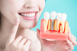 Dental-Implant-Materials-Good-Samaritan-Dental-Implants
