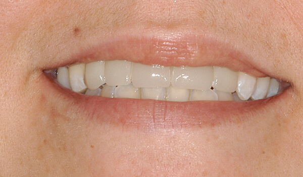 Dental-Implant-Example-Four-After-good-samaritan-implant-institute