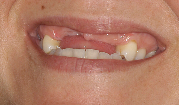 Dental-Implant-Example-Four-Before-good-samaritan-implant-institute