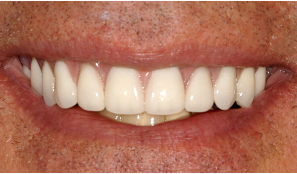Dental-Implant-Example-One-After-good-samaritan-implant-institute