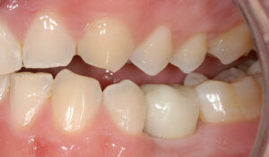 Dental-Implant-Example-eight-After-good-samaritan-implant-institute