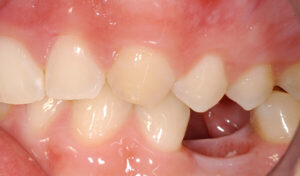 Dental-Implant-Example-eight-before-good-samaritan-implant-institute