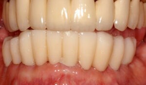 Dental-Implant-Example-five-After-good-samaritan-implant-institute