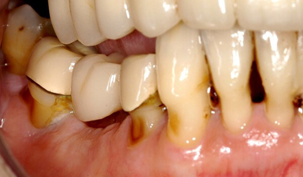 Dental-Implant-Example-five-before-good-samaritan-implant-institute