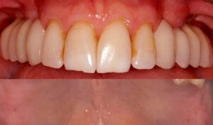 Dental-Implant-Example-nine-After-good-samaritan-implant-institute