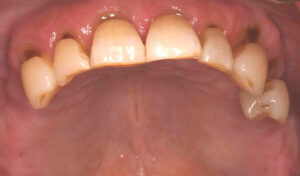 Dental-Implant-Example-nine-before-good-samaritan-implant-institute