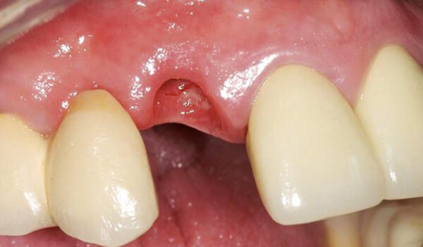 Dental-Implant-Example-six-After-good-samaritan-implant-institute