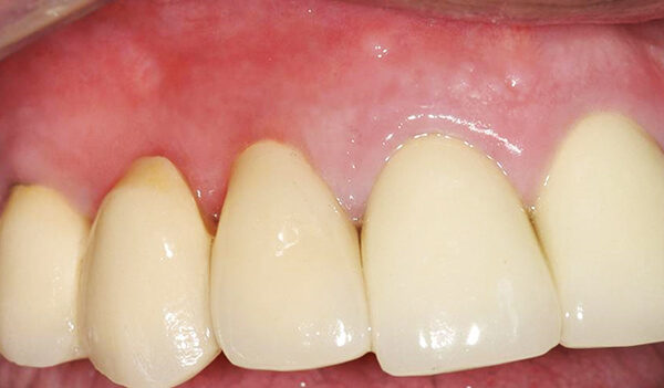Dental-Implant-Example-six-before-good-samaritan-implant-institute