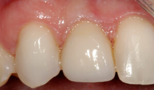 Dental-Implant-Example-three-After-good-samaritan-implant-institute