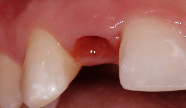 Dental-Implant-Example-three-Before-good-samaritan-implant-institute